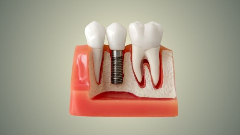 Dental Implants | JSB Dental Lab | Implant Dentistry