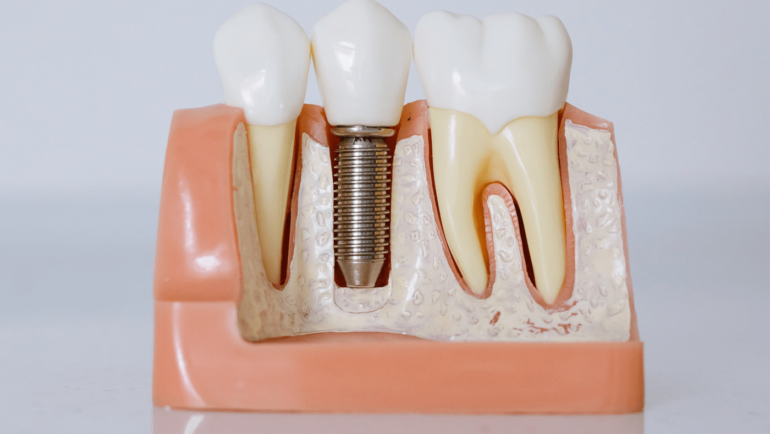 Innovations in Dental Implants: A Closer Look at JSB Dental Lab’s Expertise