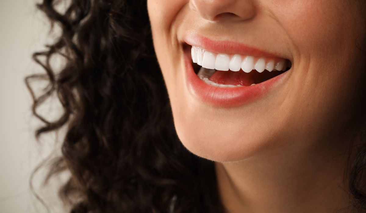 A close-up of dental crowns and veneers displayed on a model. | JSB Dental Lab