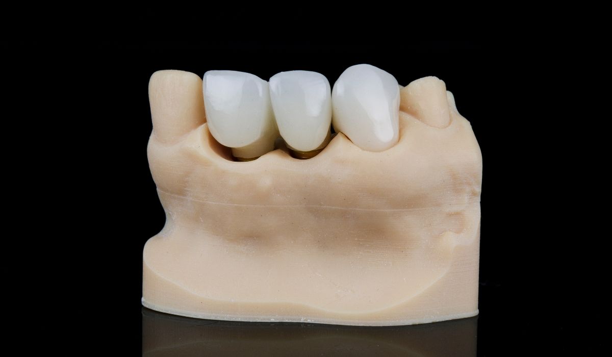 A dental crown and bridge restoration displayed on a model. | JSB Dental Lab