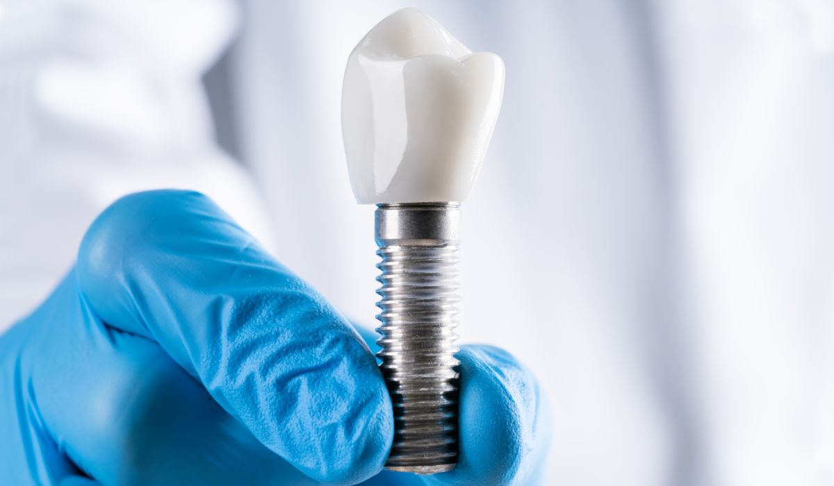 A close-up of titanium dental implants fixed into the jaw model. | JSB Dental Lab