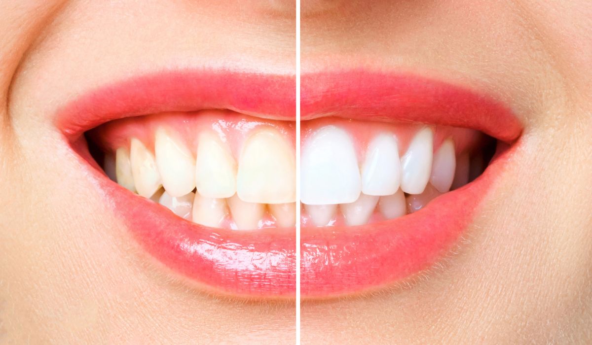 A patient undergoing professional teeth whitening treatment with UV light. | JSB Dental Lab